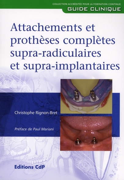 Attachements et prothèses complètes supra-radiculaires et supra-implantaires