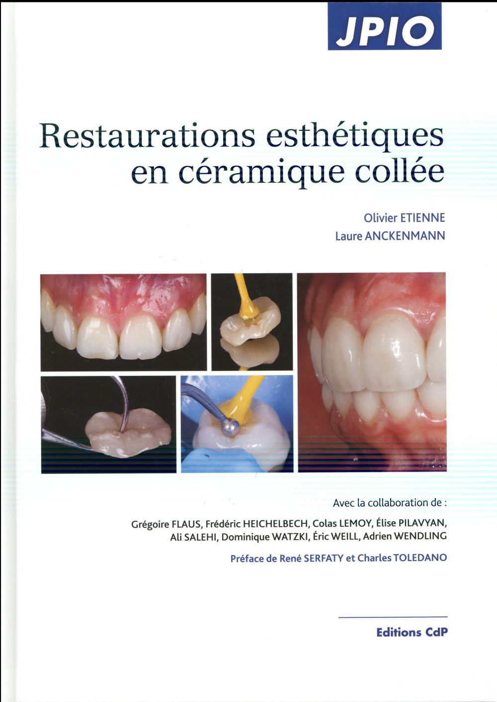 Restaurations esthétiques en céramique collée