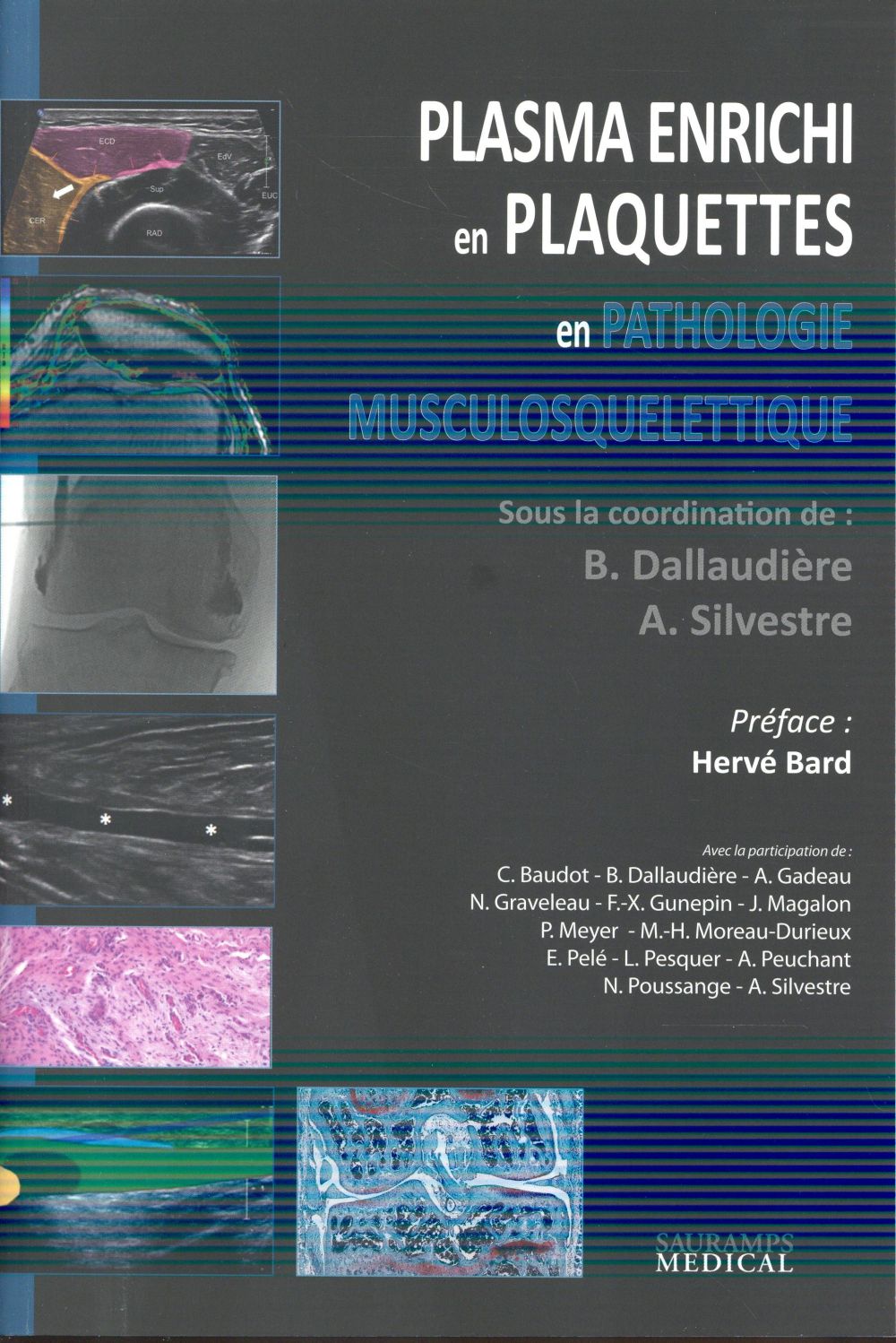 Plasma enrichi en plaquettes en pathologie musculosquelettique