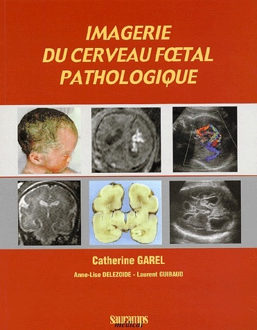 Imagerie du cerveau foetal pathologique