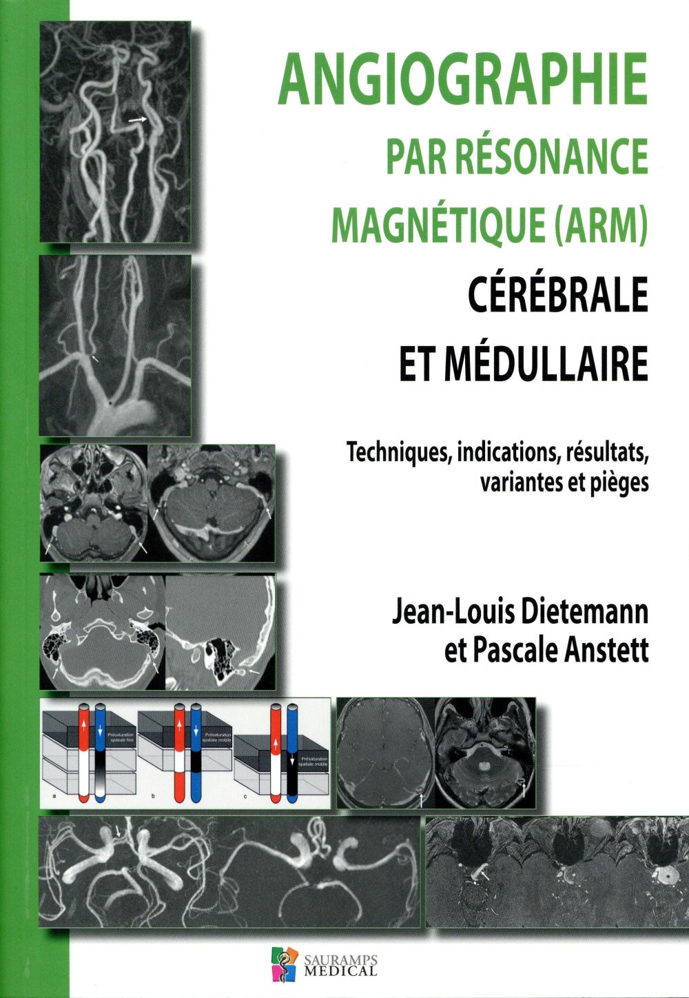 Angiographie par résonance magnétique (ARM) cérébrale et médullaire. Techniques, indications, résult