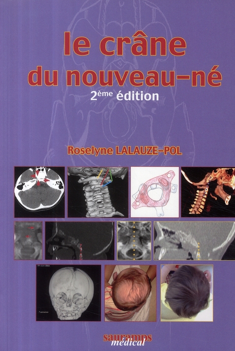 Le crâne du nouveau-né. Des contraintes foetales et leurs enjeux neurologiques aux répercussions che