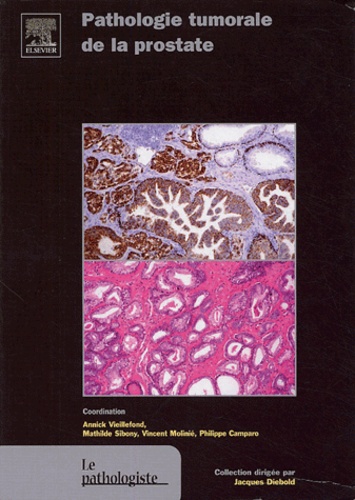 PATHOLOGIE TUMORALE DE LA PROSTATE