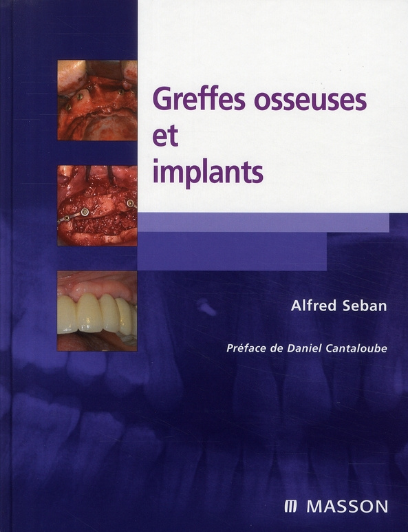 Greffes osseuses et implants