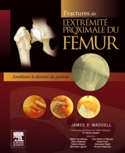 FRACTURES DE L'EXTREMITE PROXIMALE DU FEMUR - AMELIORER LE DEVENIR DU PATIENT