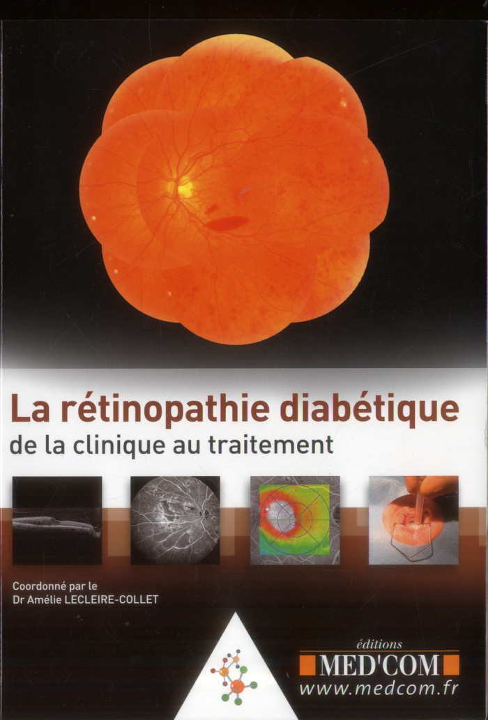 La rétinopathie diabétique