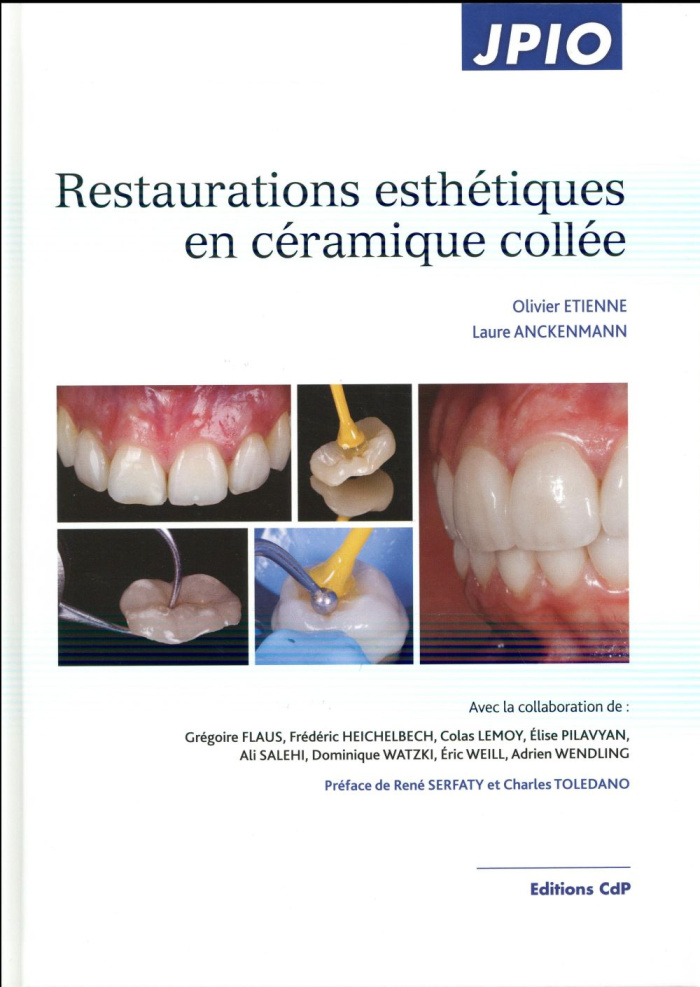 Restaurations esthétiques en céramique collée