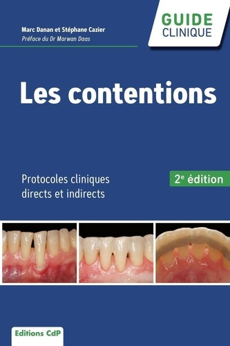 Les contentions. Protocoles cliniques directs et indirects, 2e édition