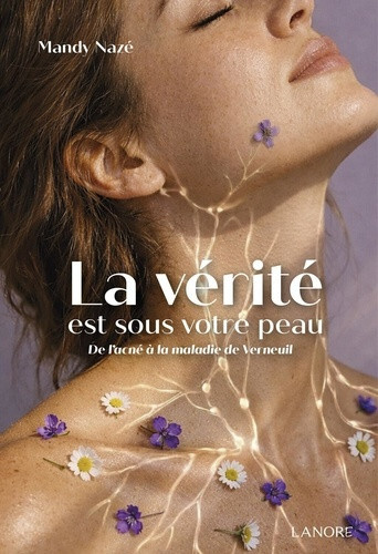 naze-mandy-la-verite-est-sous-votre-peau-de-l-acne-a-la-maladie-de-verneuil_0
