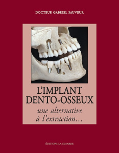 L'implant dento-osseux. Une alternative à l'extraction... - Sauveur Gabriel