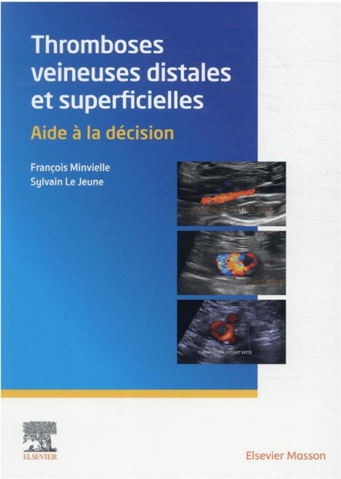 Emprunter Thromboses veineuses distales et superficielles. Aide à la décision livre