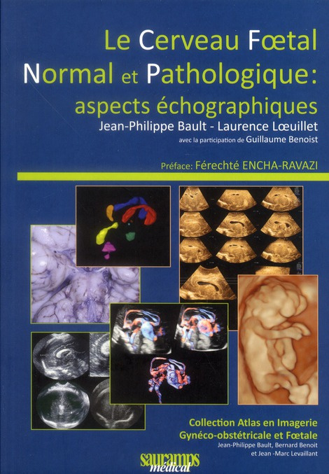Emprunter Le cerveau foetal normal et pathologique : aspects échographiques livre